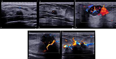 Combined Use of Shear Wave Elastography, Microvascular Doppler Ultrasound Technique, and BI-RADS for the Differentiation of Benign and Malignant Breast Masses